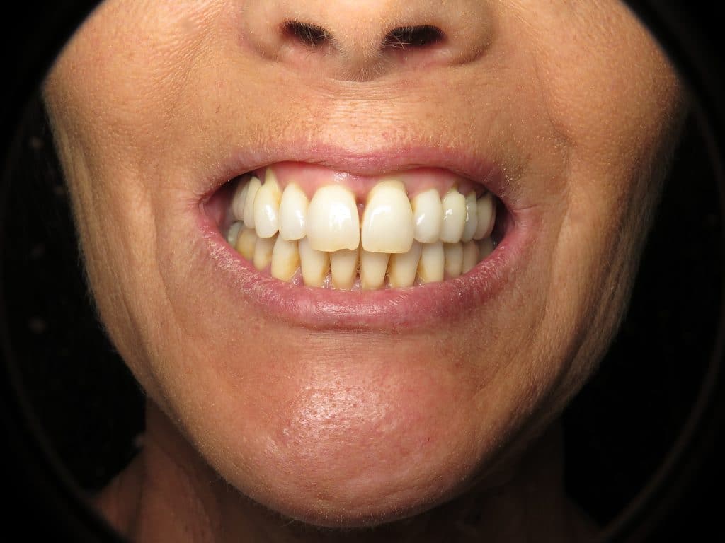 Long teeth smile with gum disease and bone loss