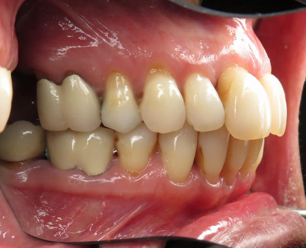 Side view teeth with bone loss