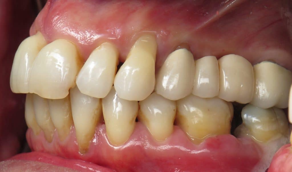 Side view teeth with bone loss