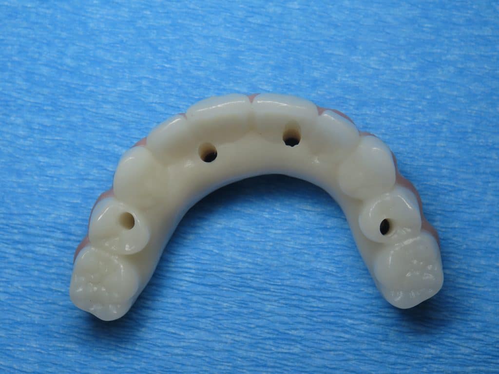 Upper All on 4 prototype temporary teeth