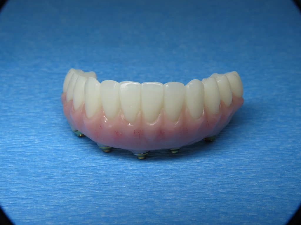 Lower All on 4 prototype temporary teeth