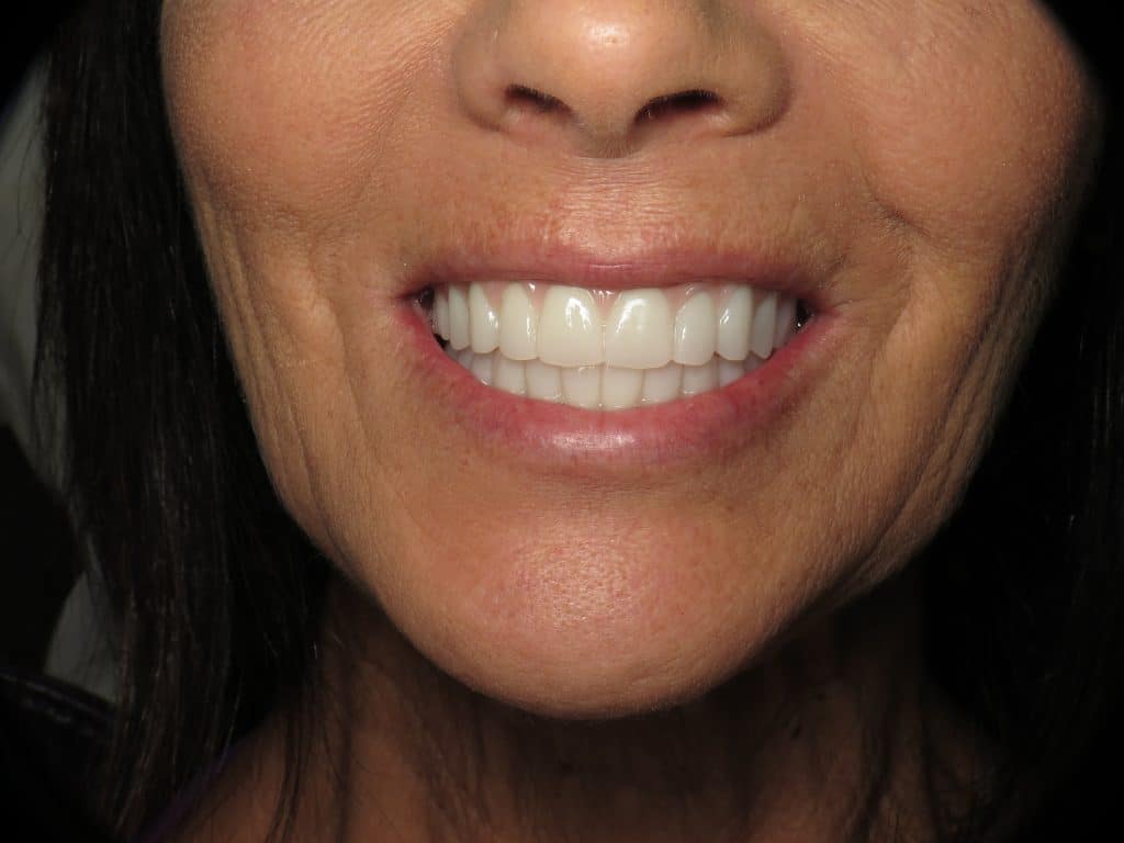 All on 4 prototype temporary teeth smile view