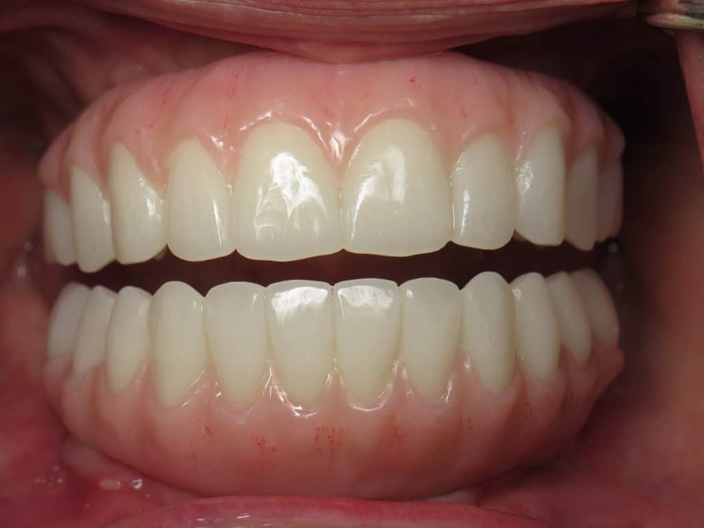 All on 4 prototype temporary teeth