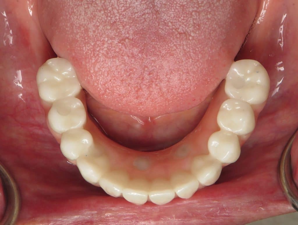 Lower dental implant zirconia bridge