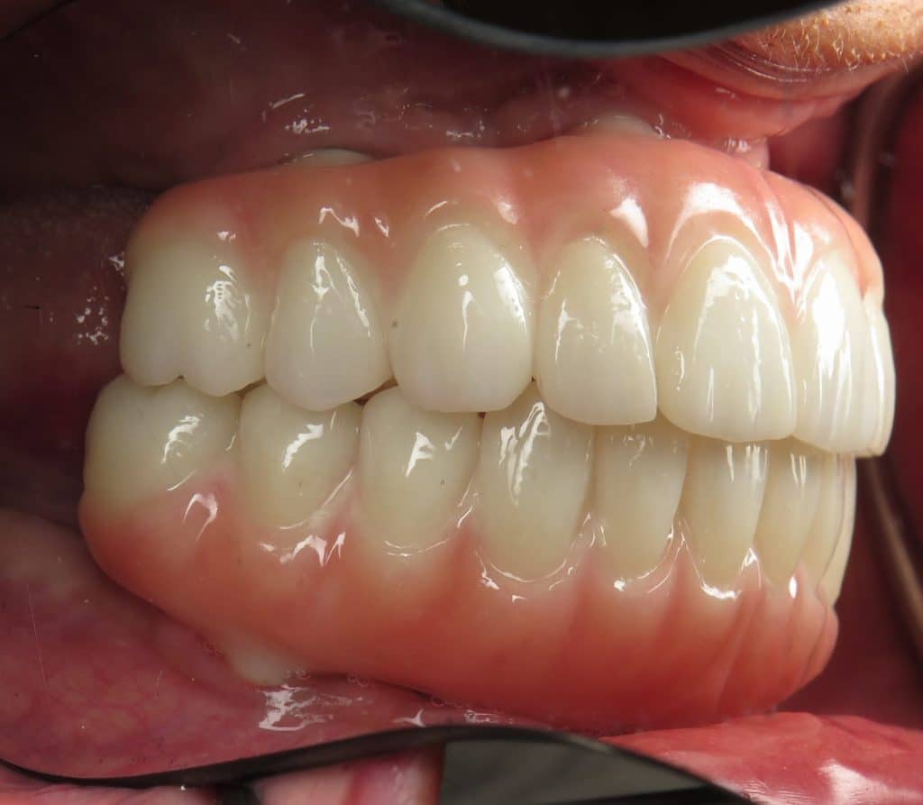 All on 4 zirconia bridges - side view in mouth
