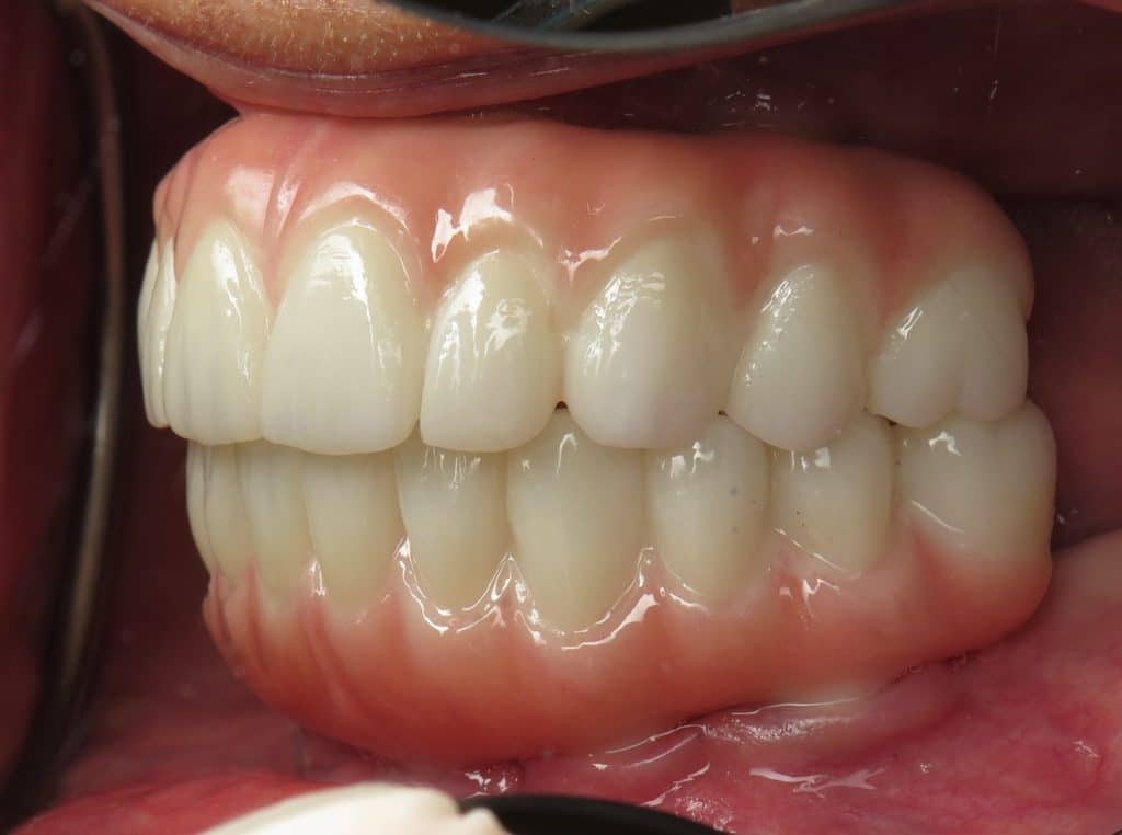 All on 4 zirconia bridges - side view in mouth