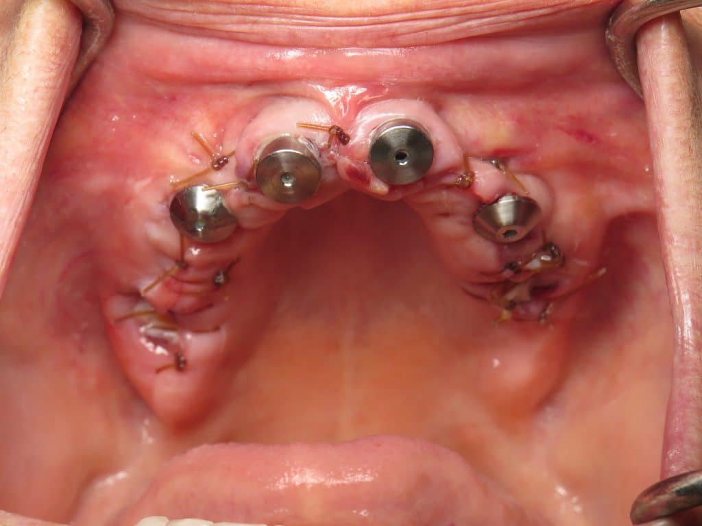 Upper All on 4 dental implants - Sutures next day appearance