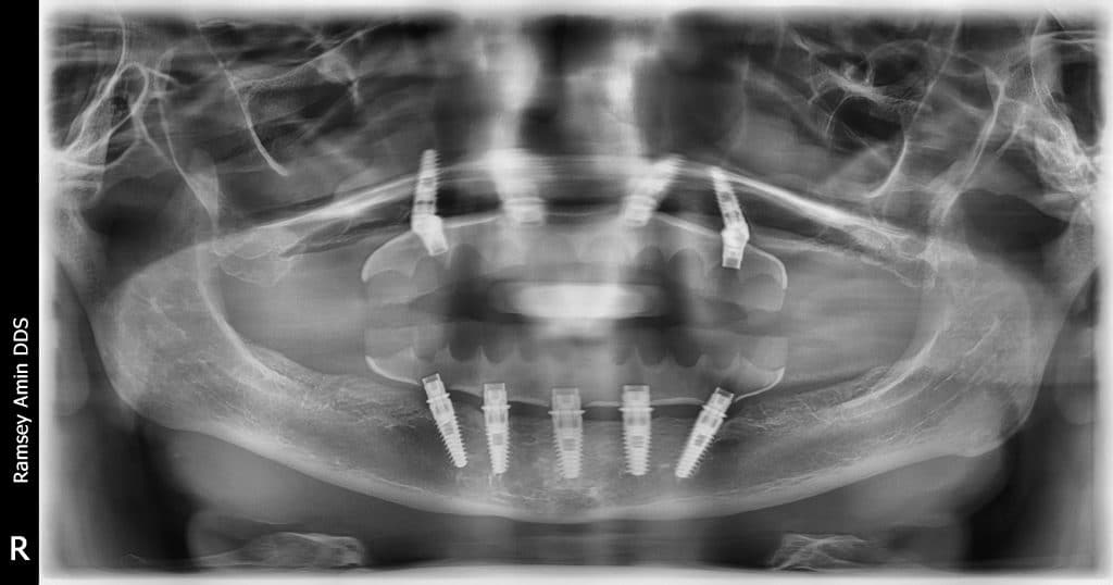 X-ray Full mouth All on 4/5 dental implants with prototype teeth