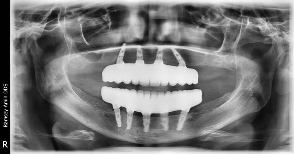 X-ray Full mouth All on 4/5 dental implants with zirconia teeth