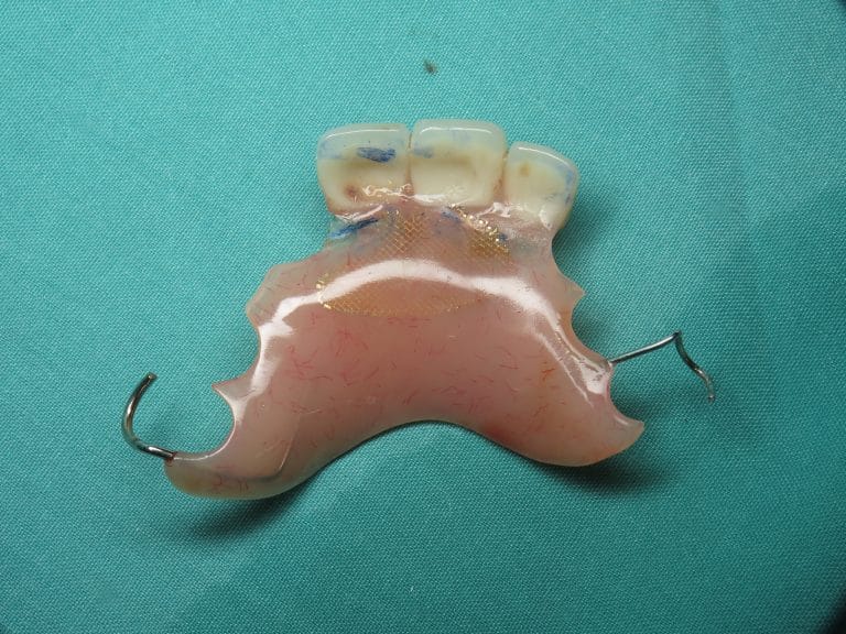 stayplate Archives Burbank Dental Implants