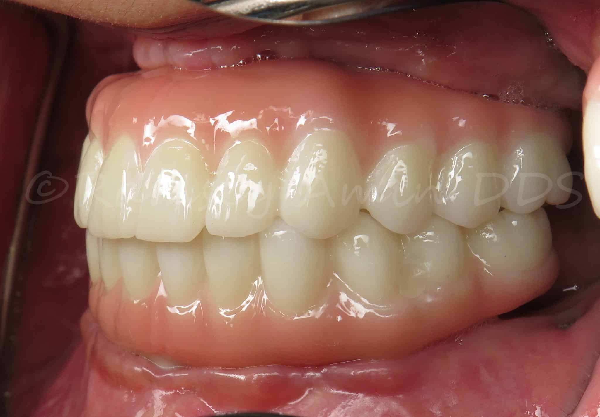 Quad Zygomatic Dental Implants To Replace Dentures Without Bone