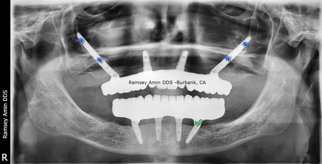 double zygomatic dental implants x-ray by Dr. Ramsey Amin of Burbank Dental Implants