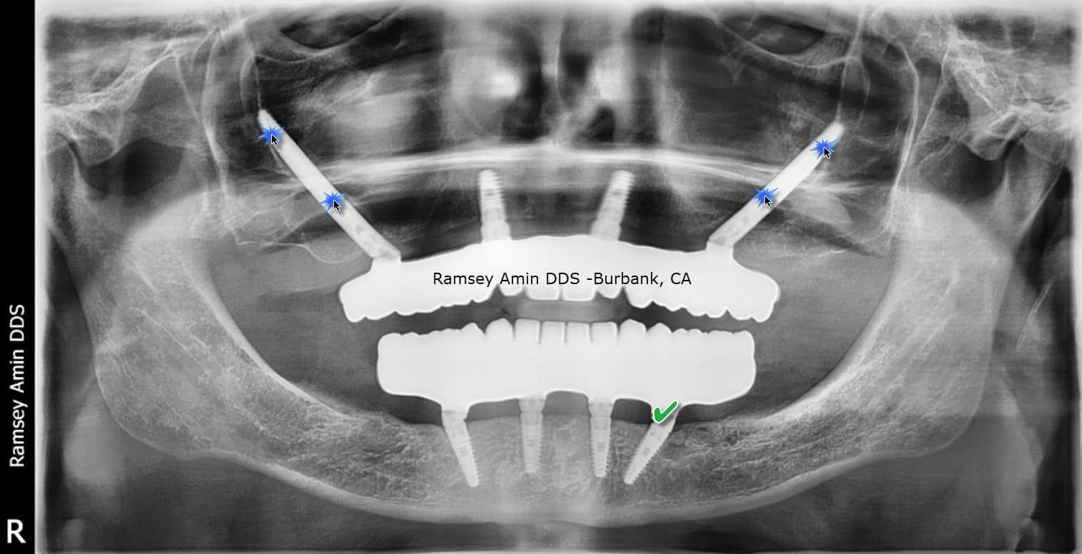 AllOn4 Dental Implant Problems And Complications