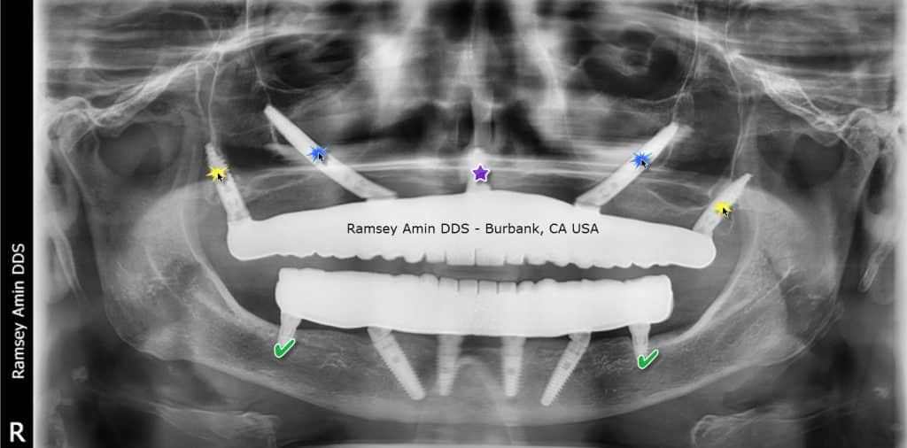 Combination zygomatic, pterygoid and nasal dental implant x-ray.