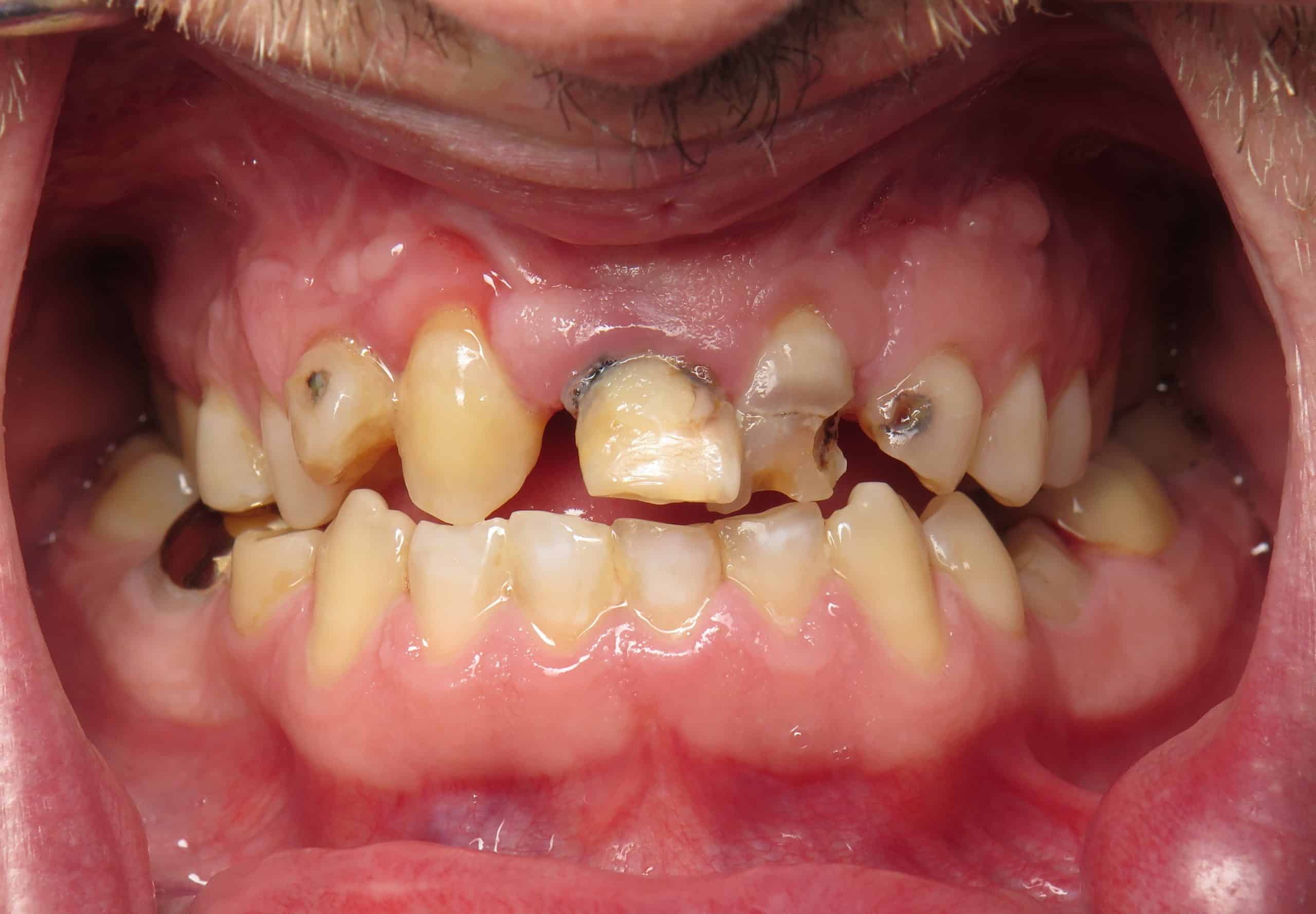 Dental Implants for Cleft Palate Ramsey Amin DDS in Burbank, CA