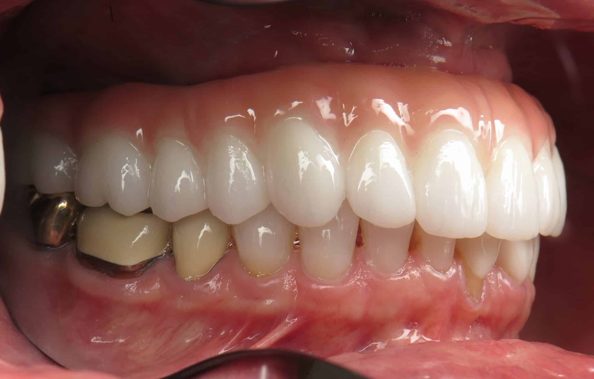 Gap/Space Under My Implant Bridge