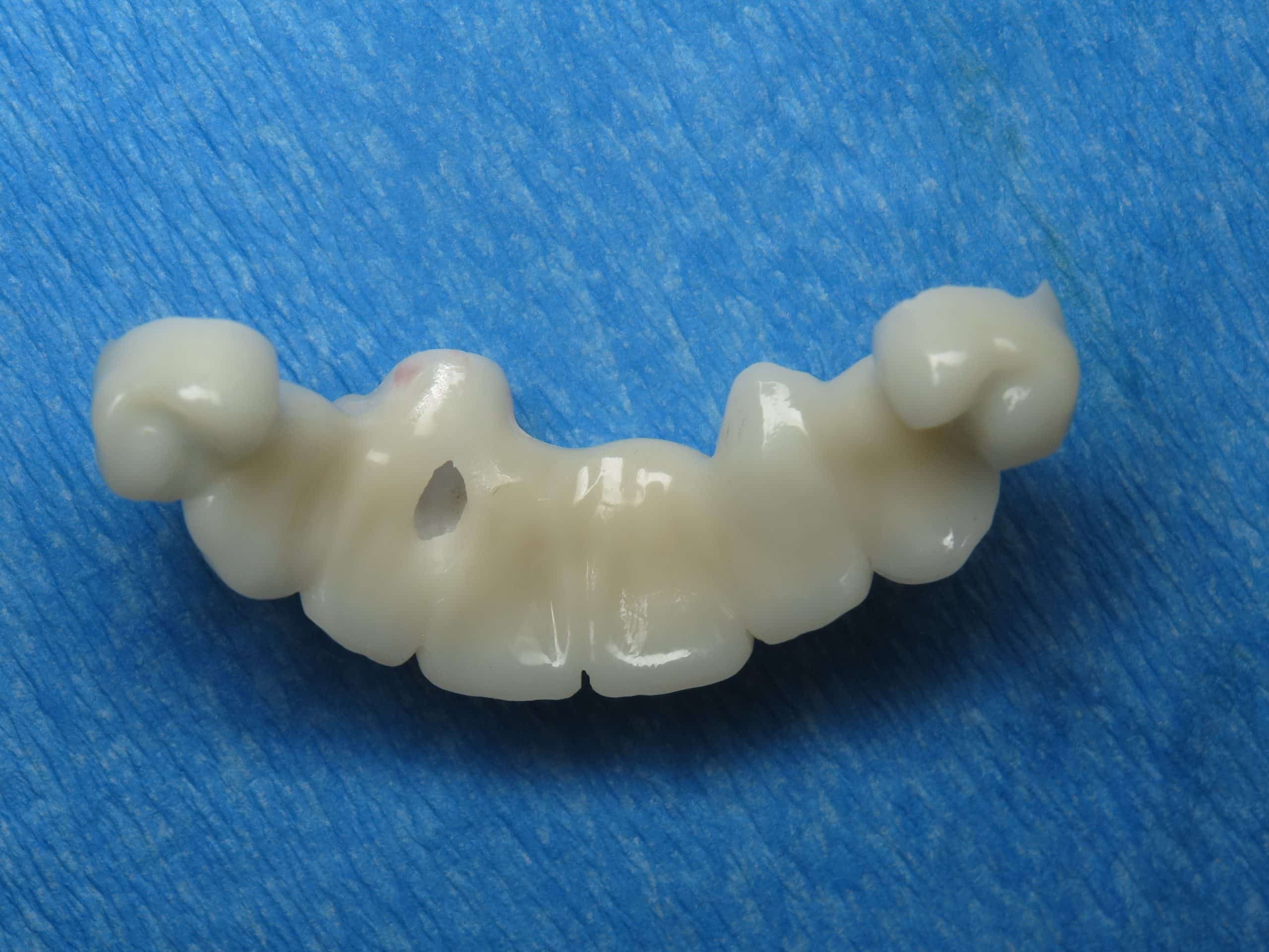 Dental Implants for Cleft Palate Ramsey Amin DDS in Burbank, CA