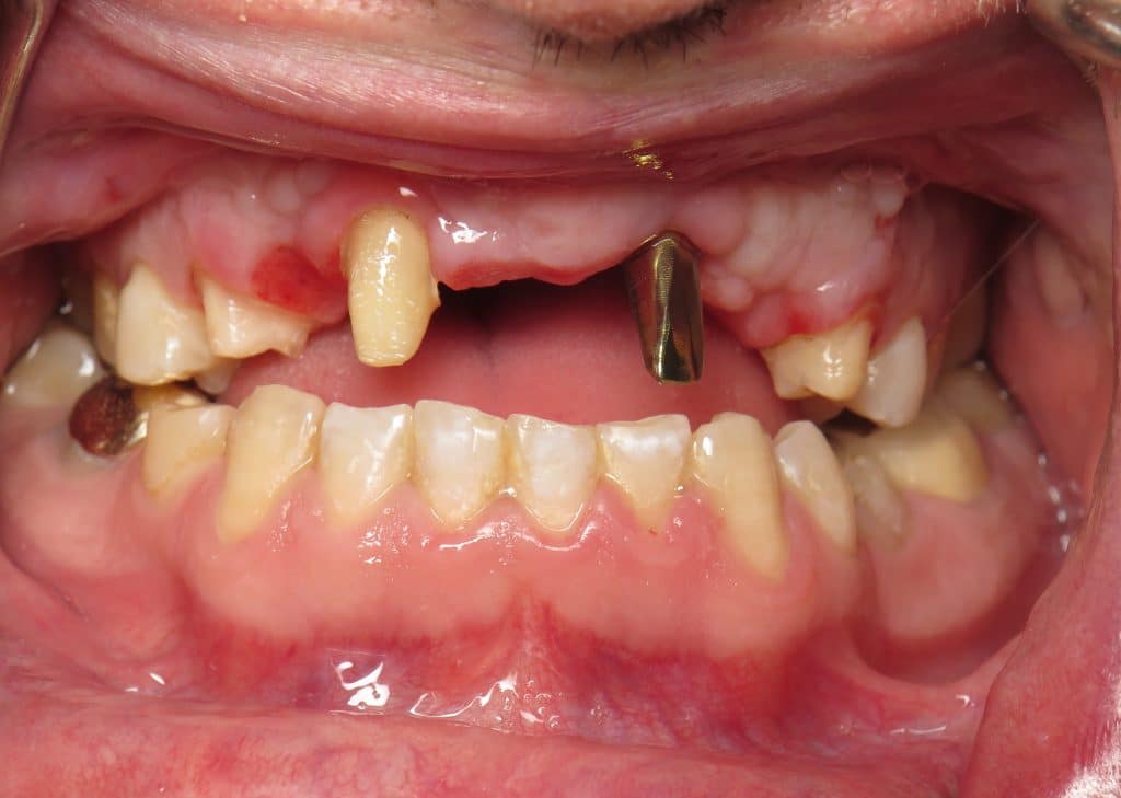 Implant for cleft lip/palate solution