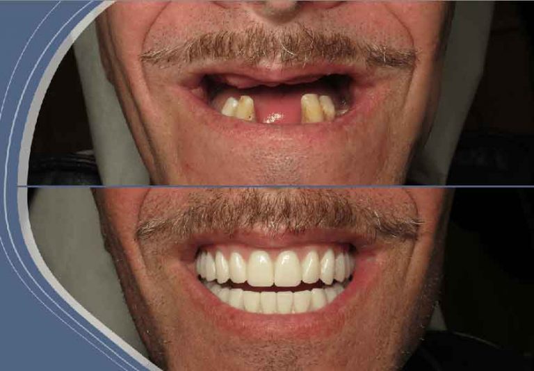 Fast Dental Implants and Dentures Burbank, CA Dr. Ramsey Amin