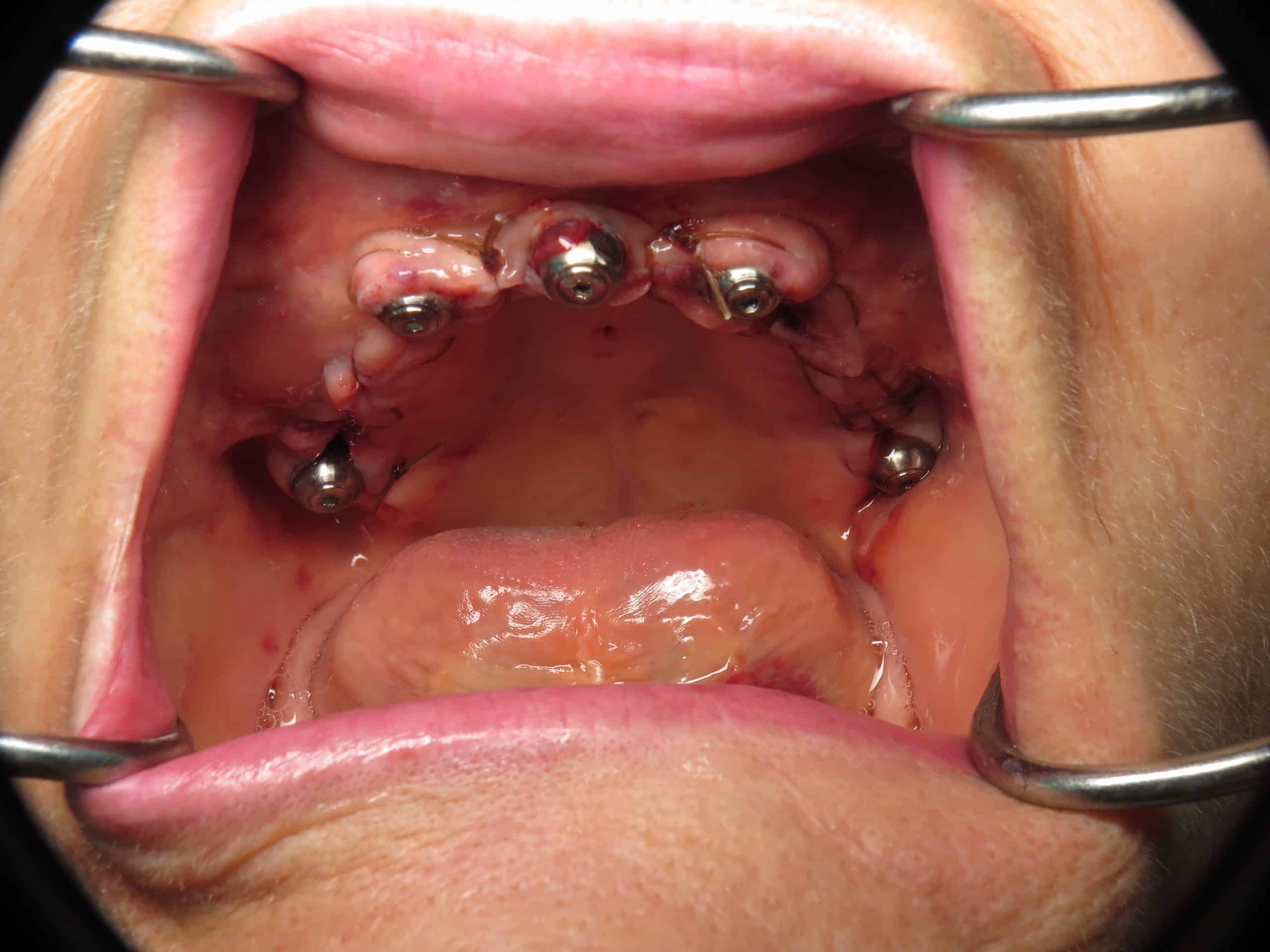 Pterygoid dental implant day of surgery with sutures in place