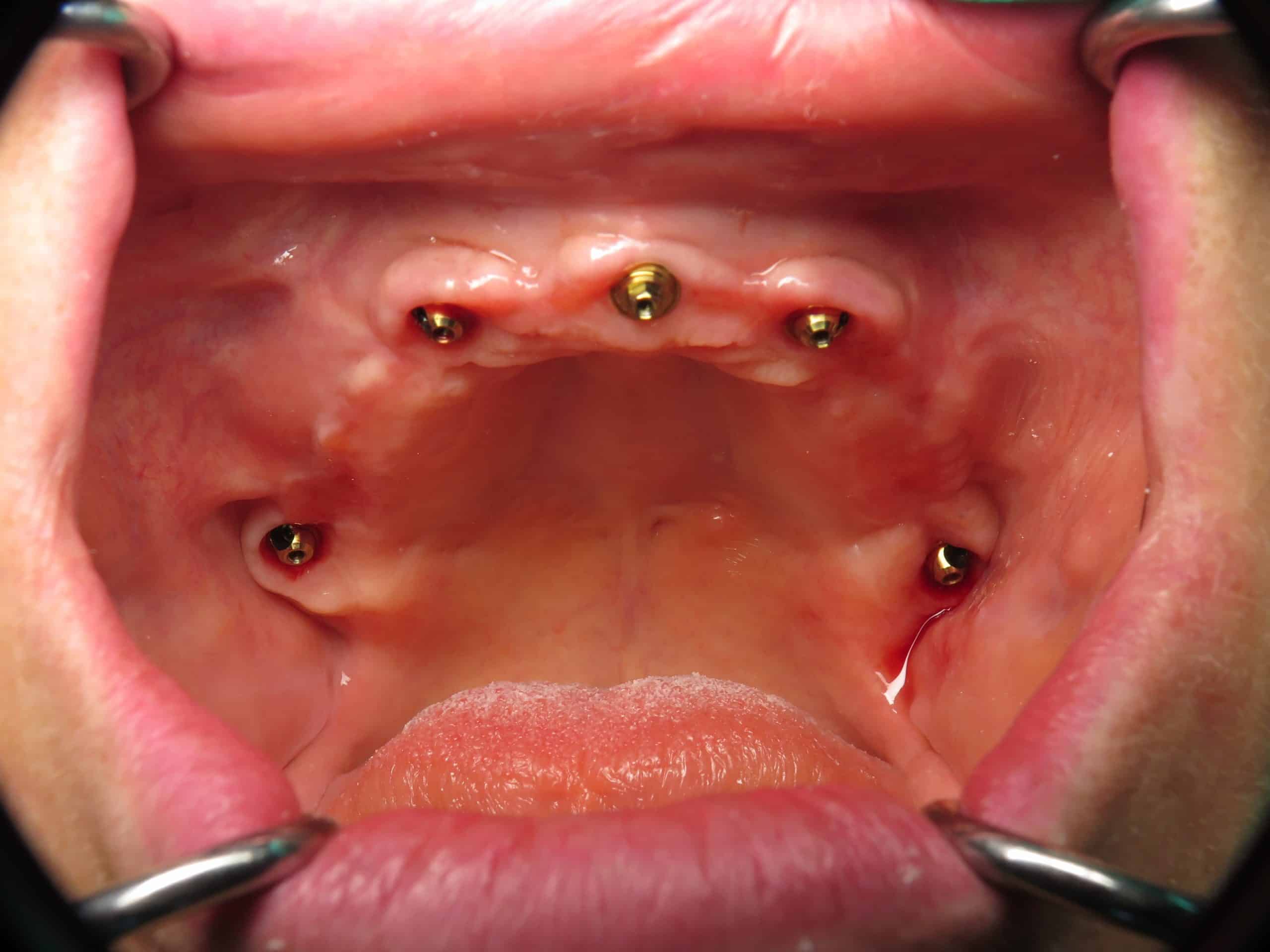 Pterygoid implants in the very back of the mouth on the right and left
