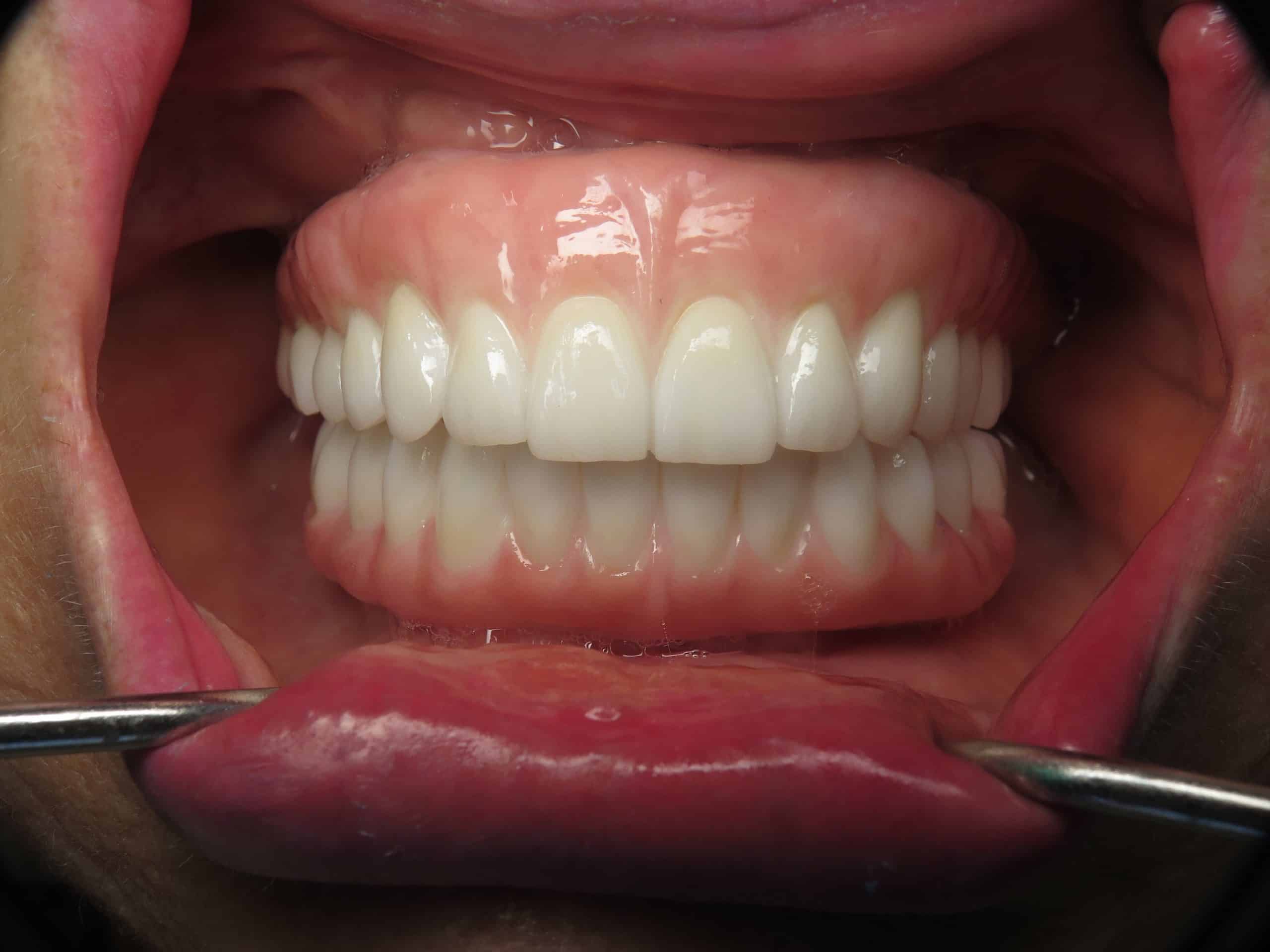Pterygoid implants used zirconia dental implant bridge