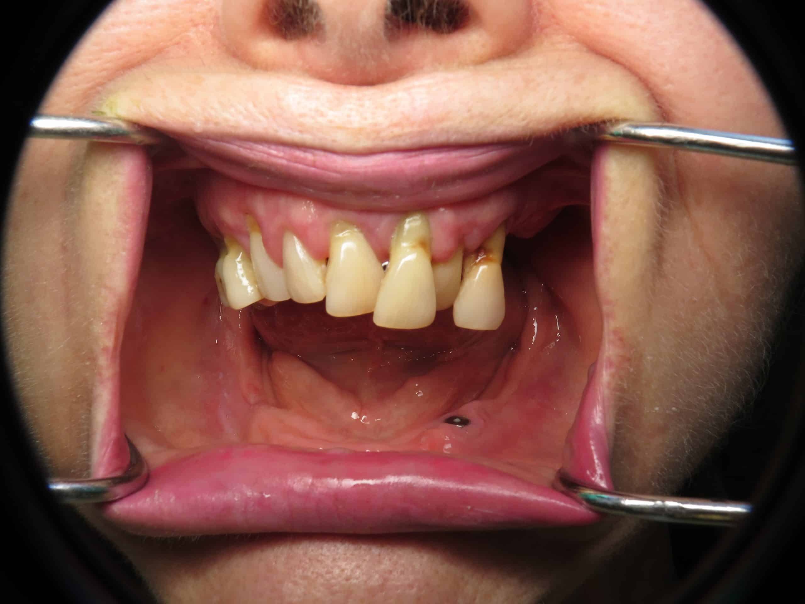 Severe gum disease and missing lower teeth