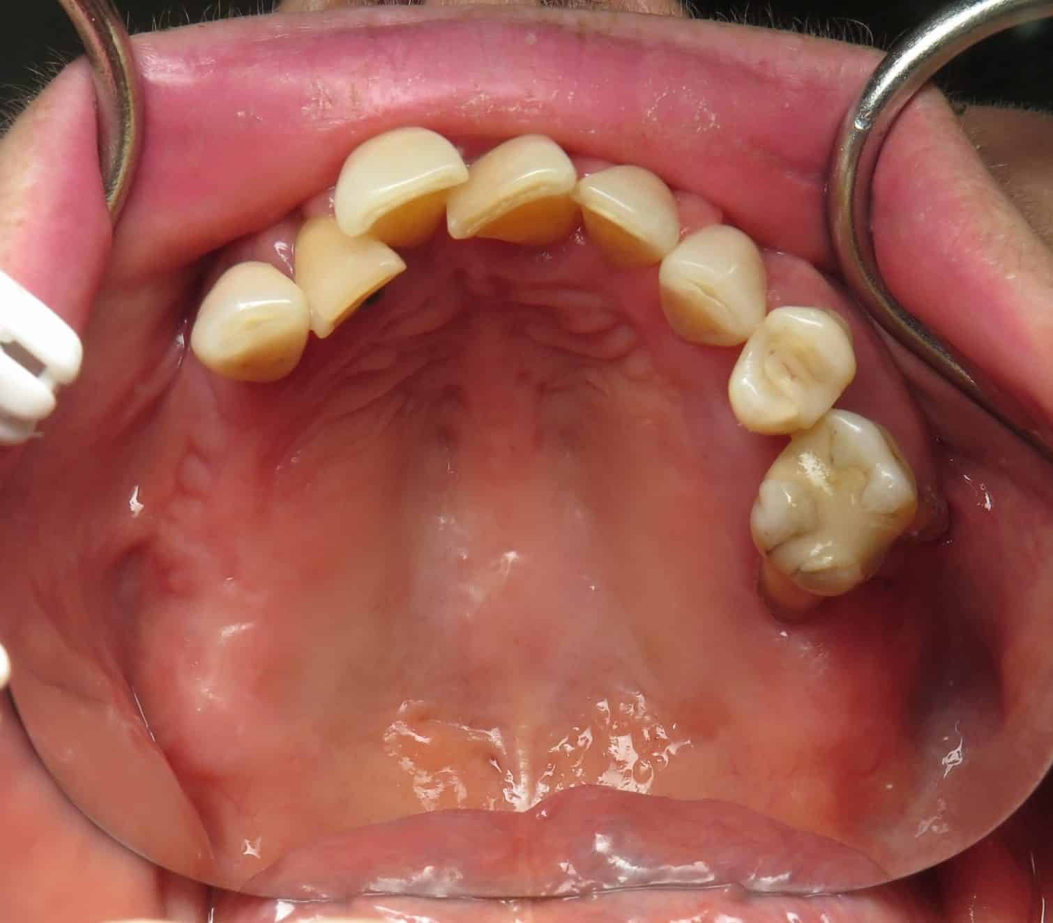 Upper jaw with missing teeth showing pterygoid anatomy