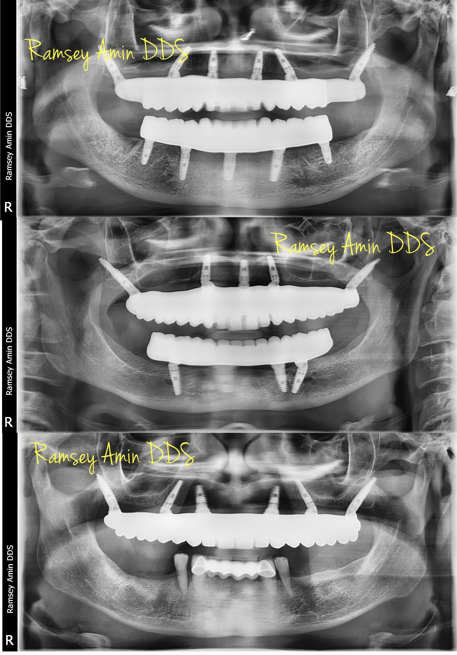Pterygoid implant x-rays