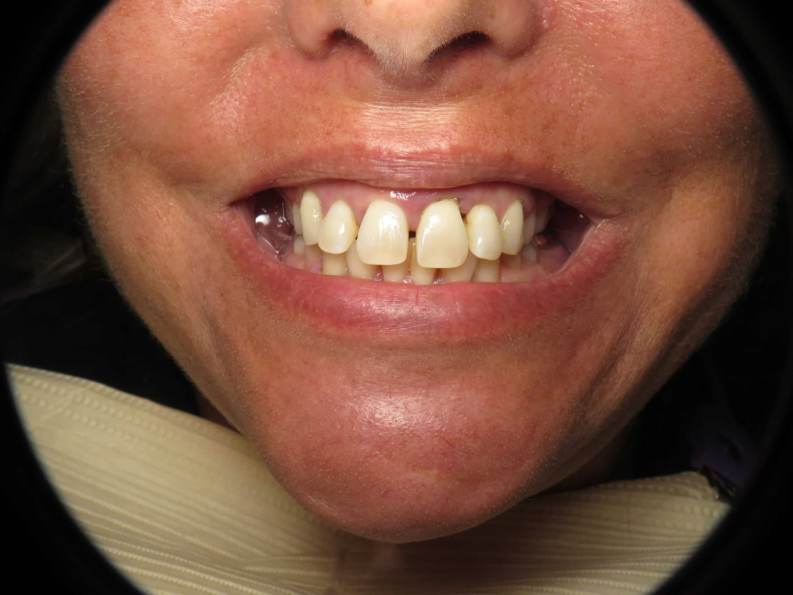 Teeth with gum disease