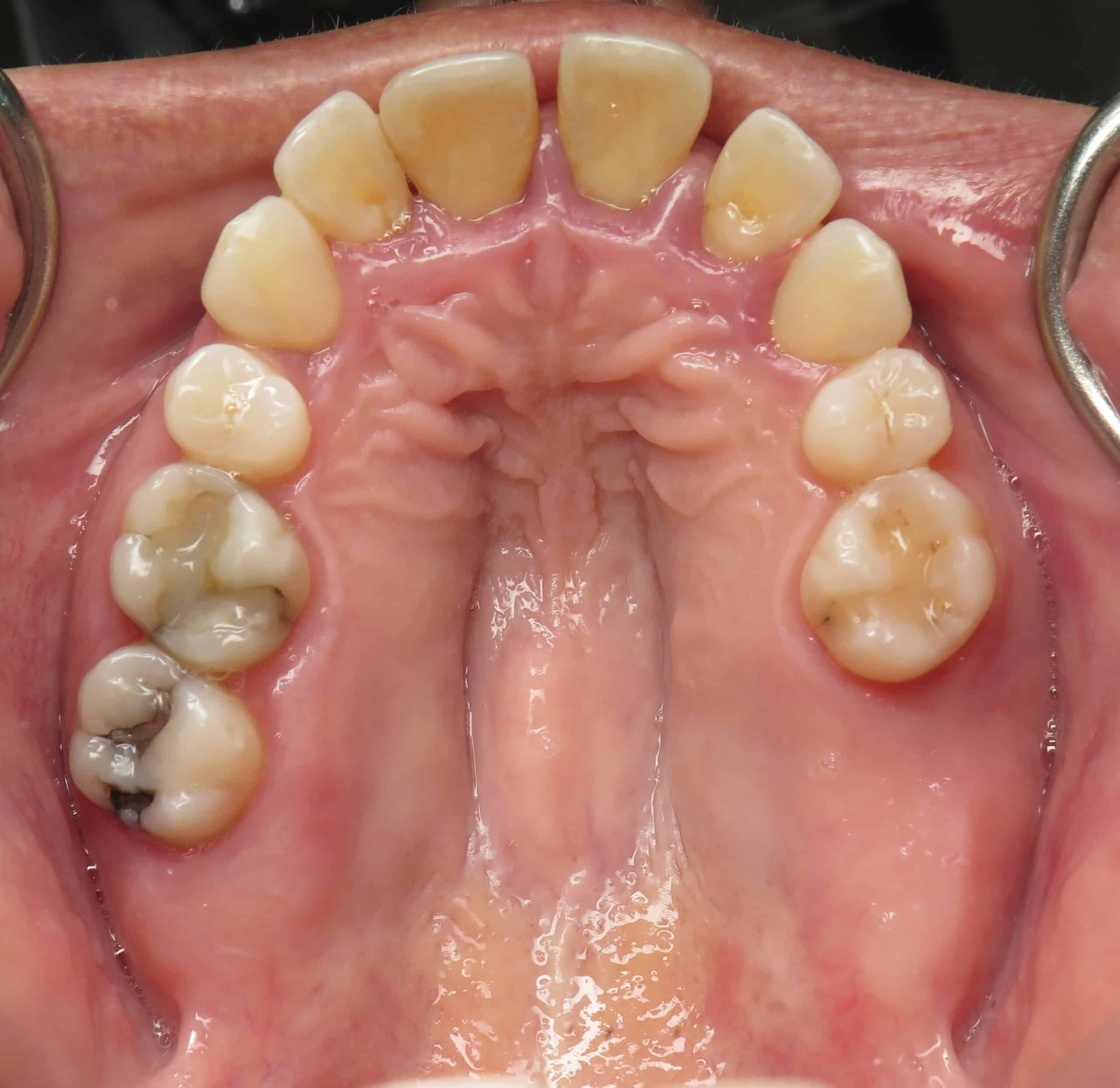 Teeth with gum disease
