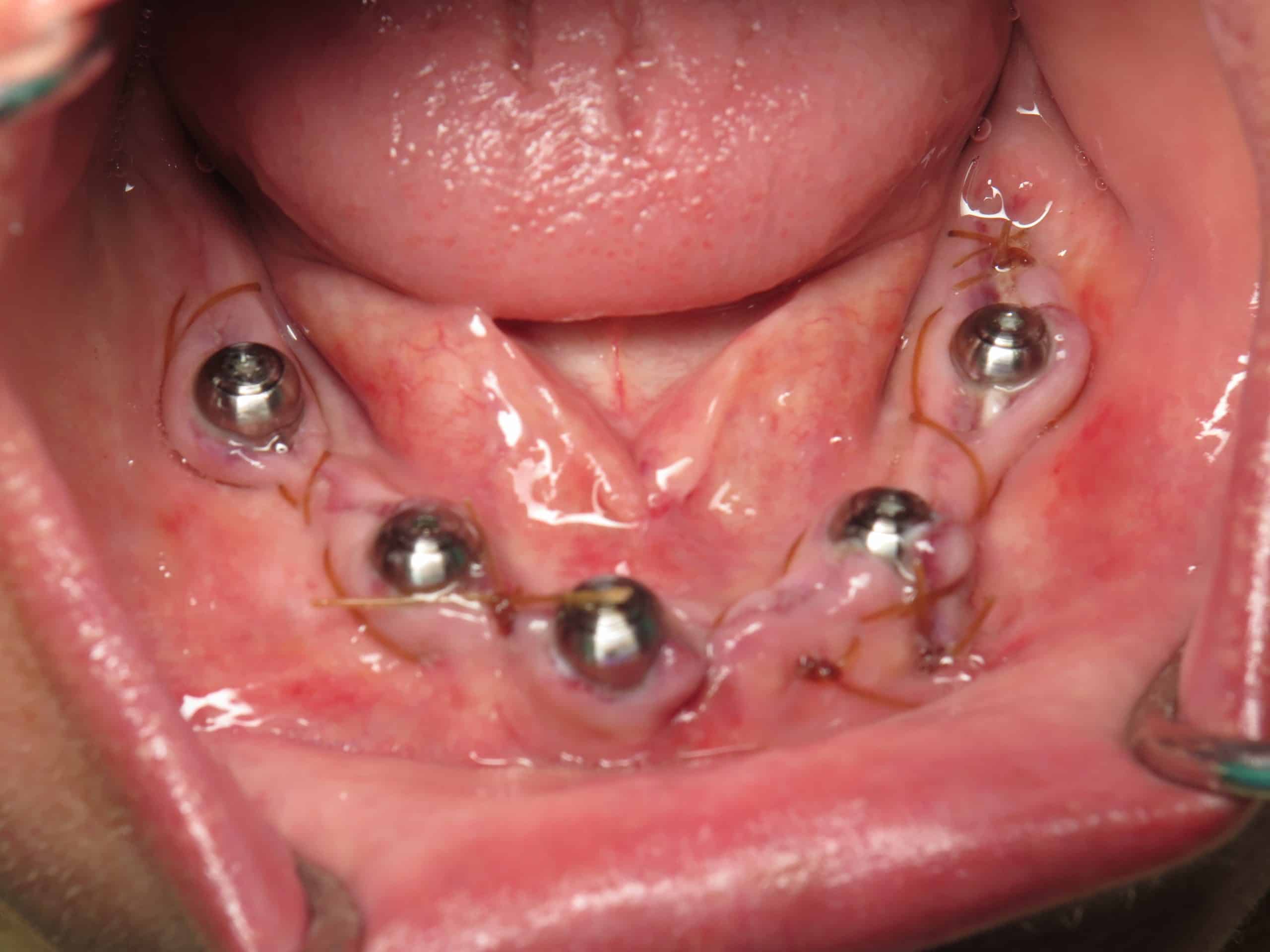 Healing dental implants next day with sutures