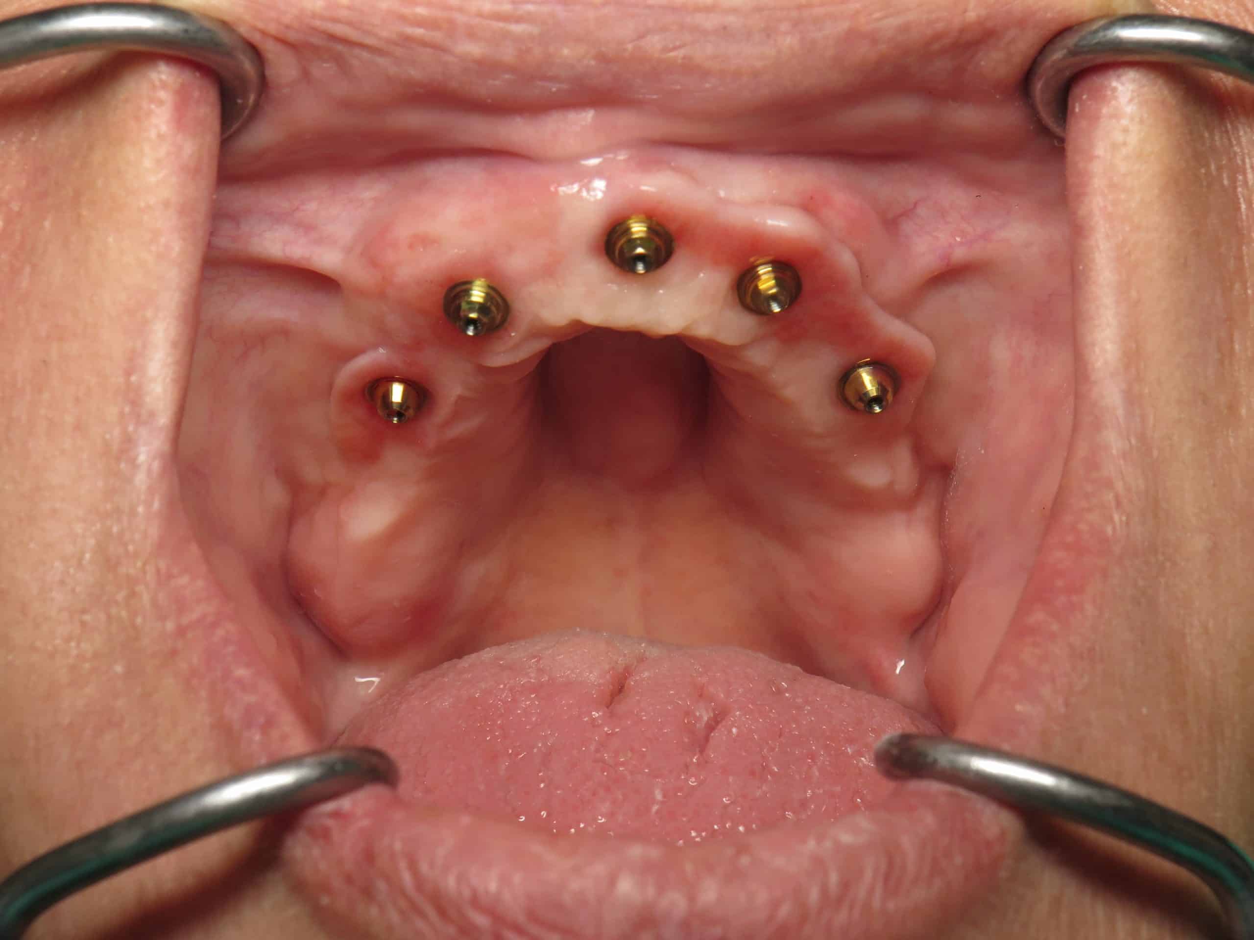 Upper Multi Unit abutments in gums