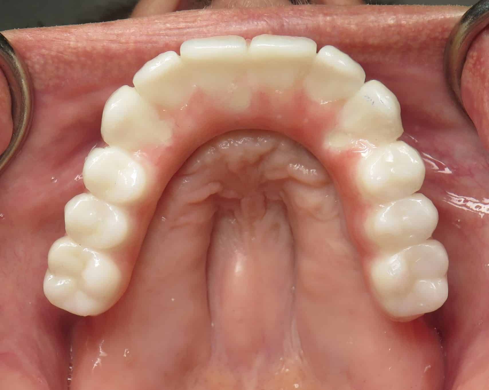 Top teeth full implants