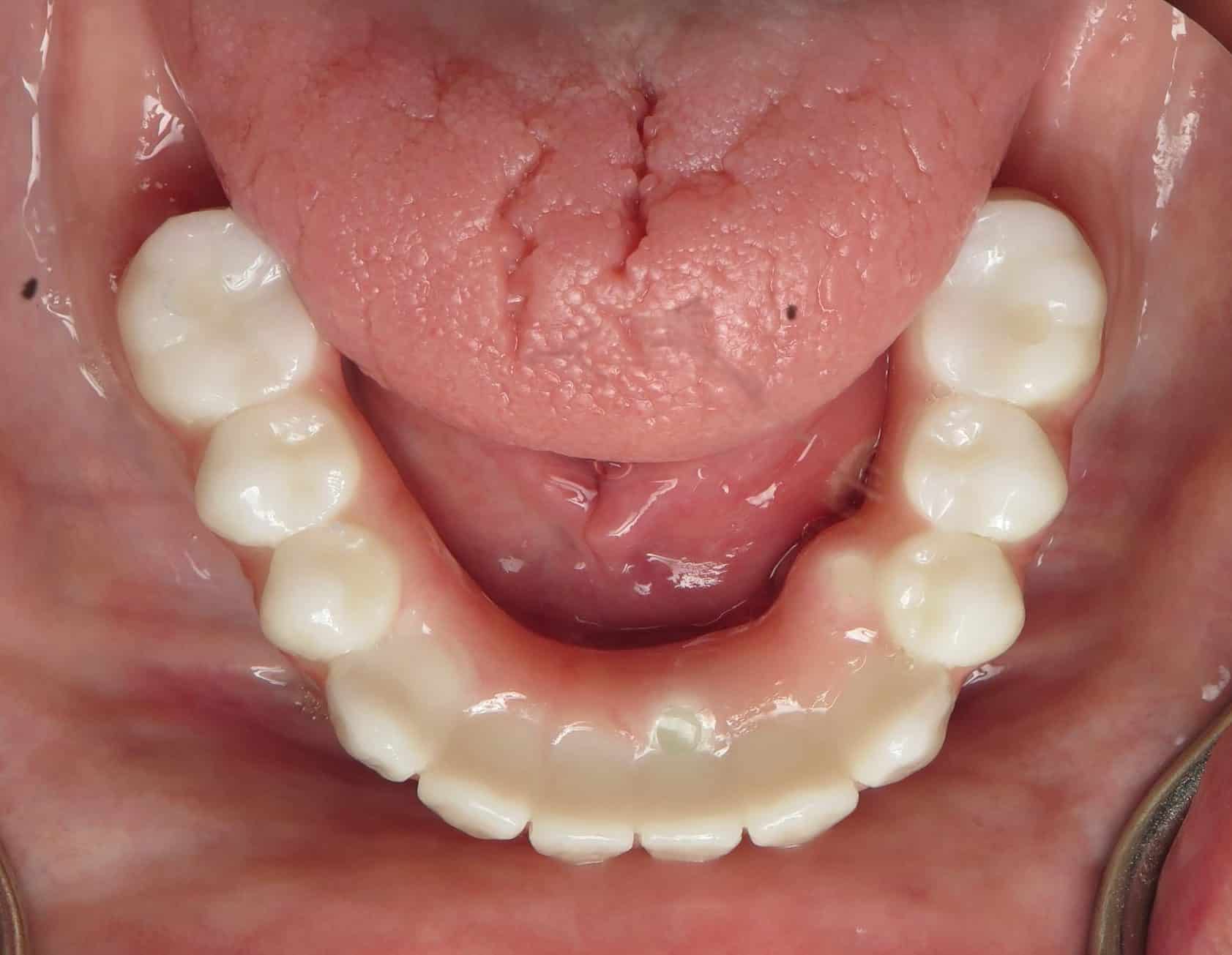 Bottom teeth full implants