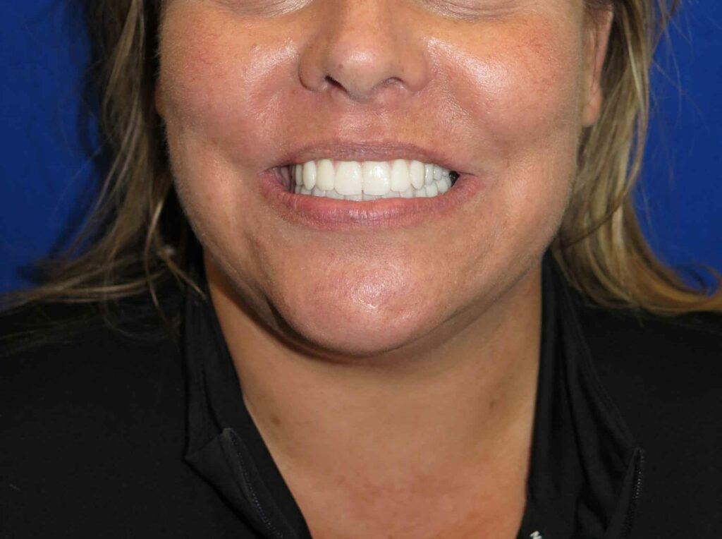 Smile after dental implants