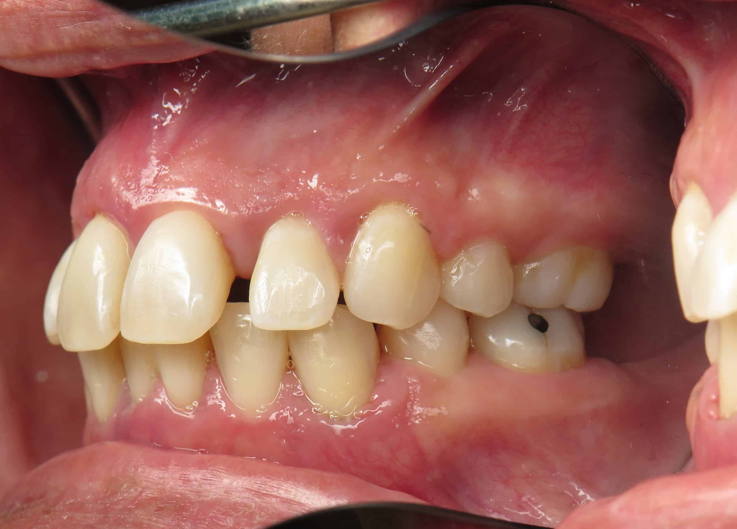 Teeth with hidden gum problems/bone loss
