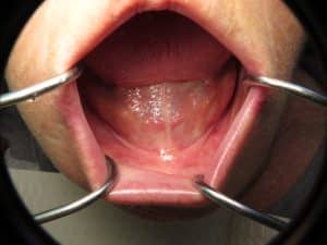 Severe bone loss lower jaw