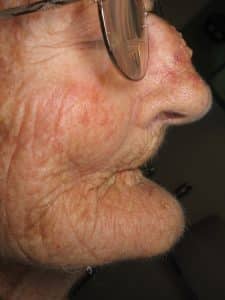 Facial photo of severe bone loss of upper and lower jaw-side profile