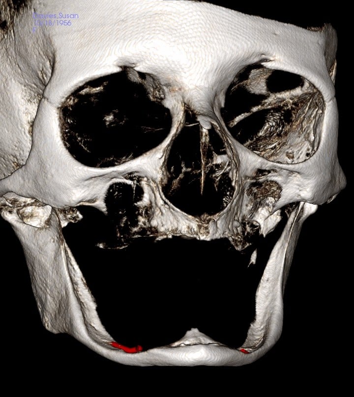 Severe Lower Jaw Bone Loss CBCT