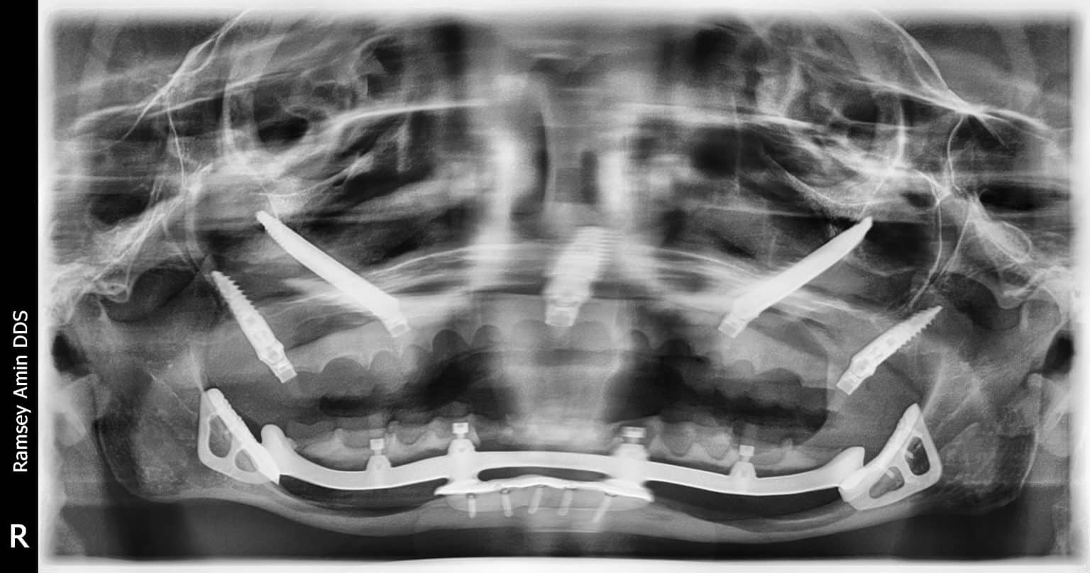 What is Periimplantitis and What Do I Do About It? Bone Loss Around Dental Implants Burbank