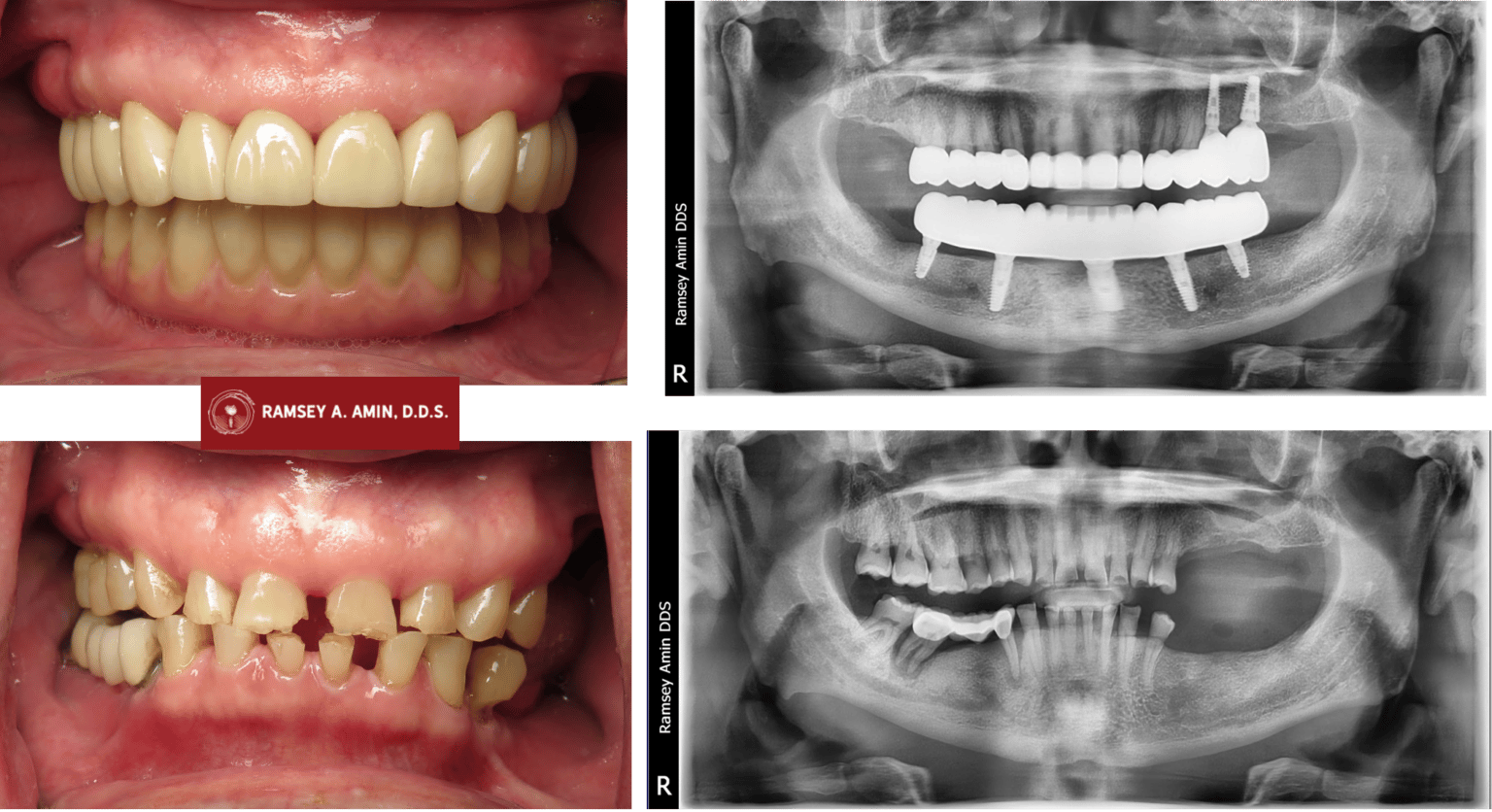 Botox® for Teeth Grinding, Jaw Clenching & Dental Implants