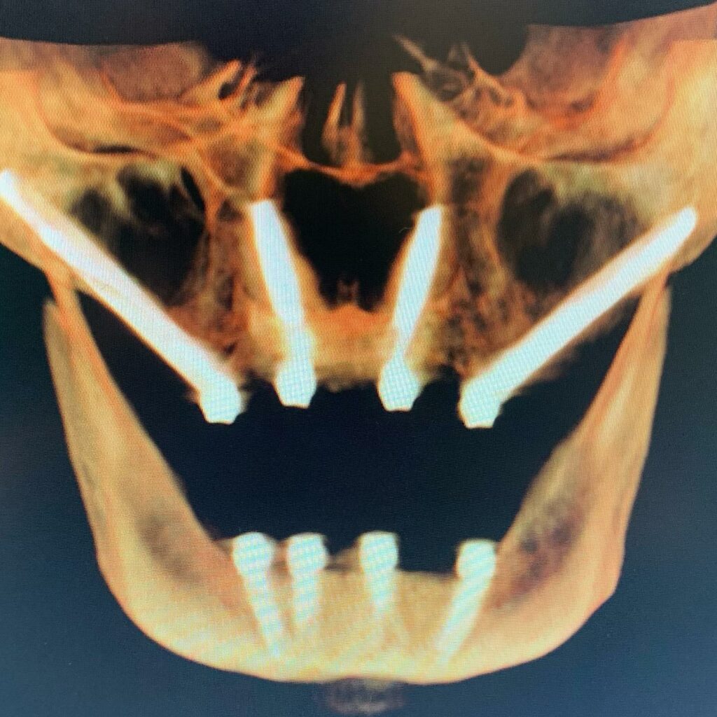TransNasal Dental Implants To Avoid Quad Zygomatic Implants For AllOn4/X