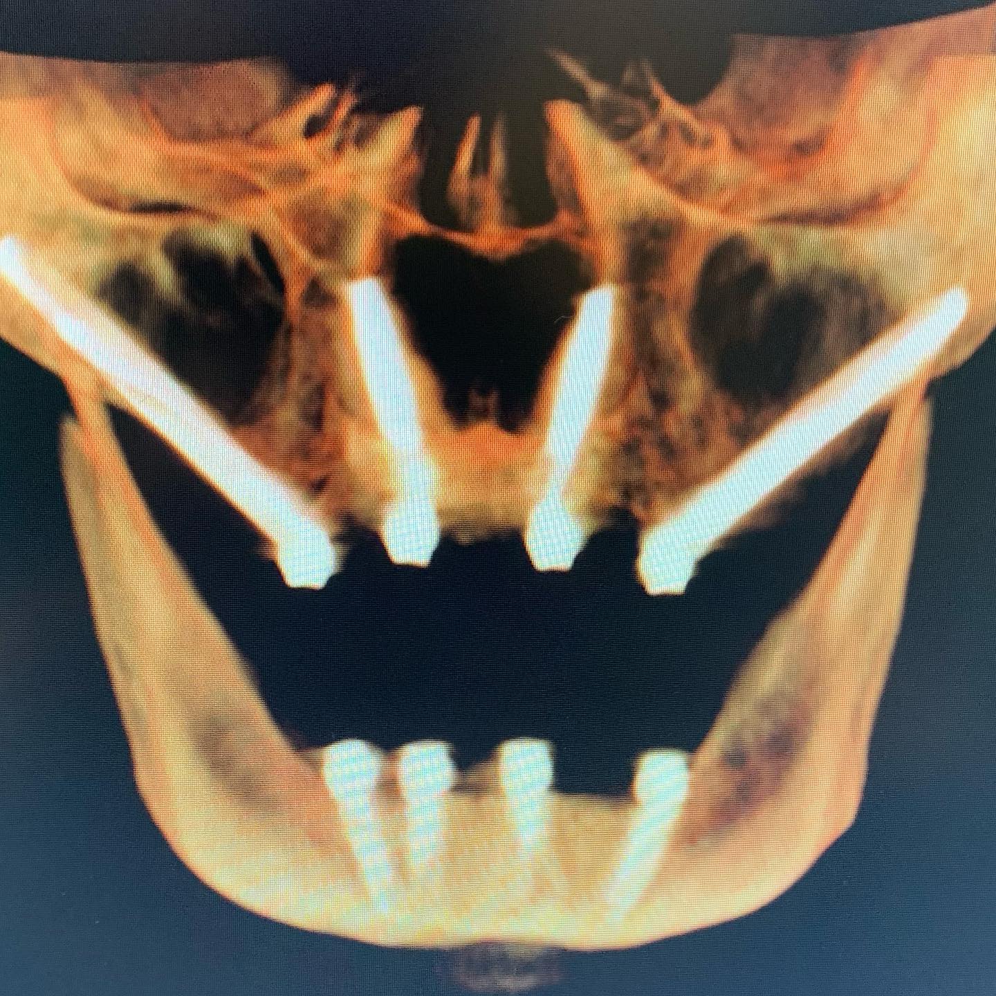 TransNasal Dental Implants To Avoid Quad Zygomatic Implants For AllOn4/X