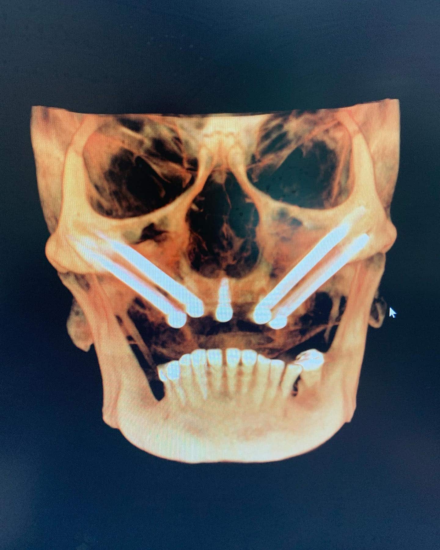quad zygomatic quad zygomatic dental implants with one regular implant in the center