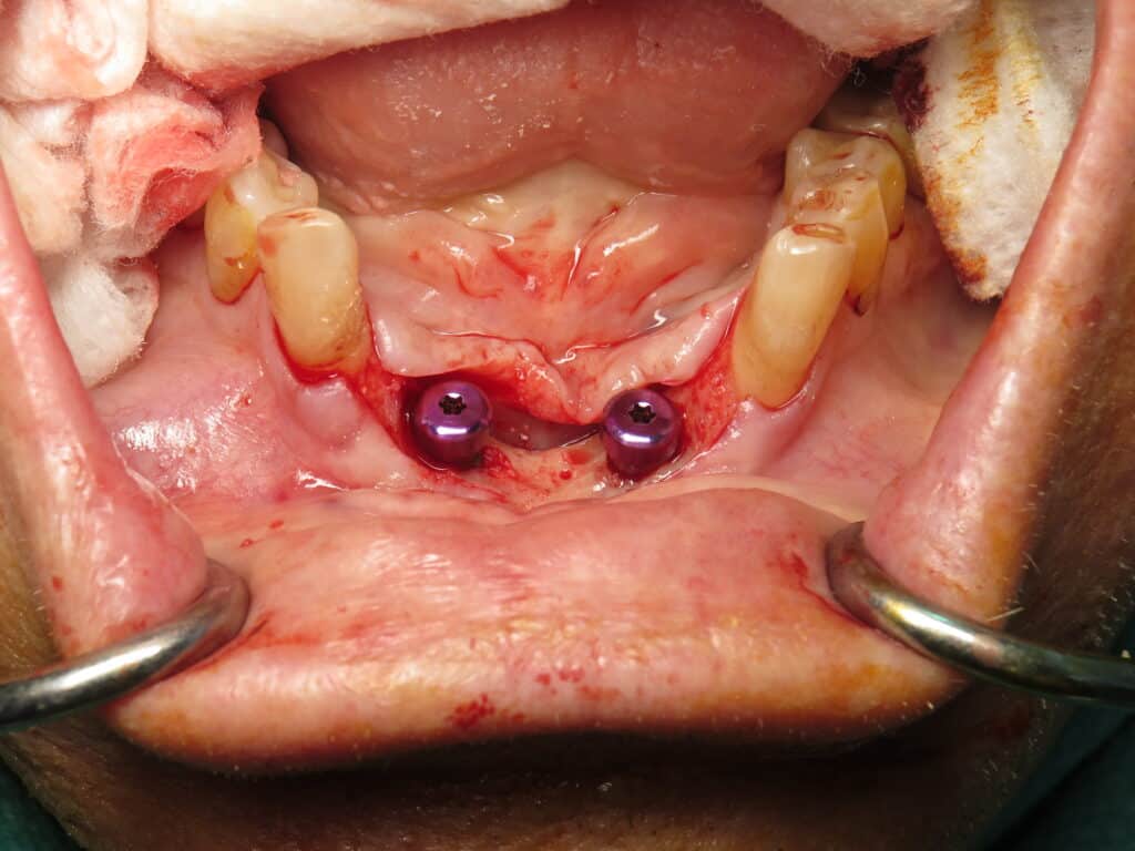 Day of surgery placing 2 dental implants and pushing half of the grafted gum to the inside and the other half to the outside