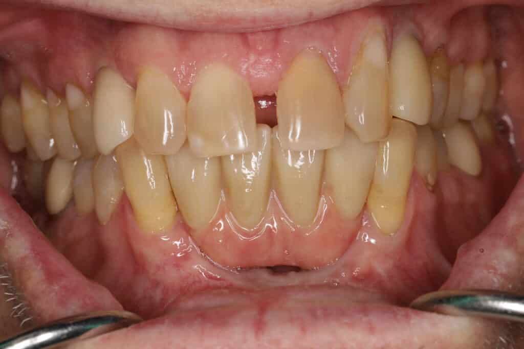 1 year follow up: No bone grafting only gum grafting lower front dental implants