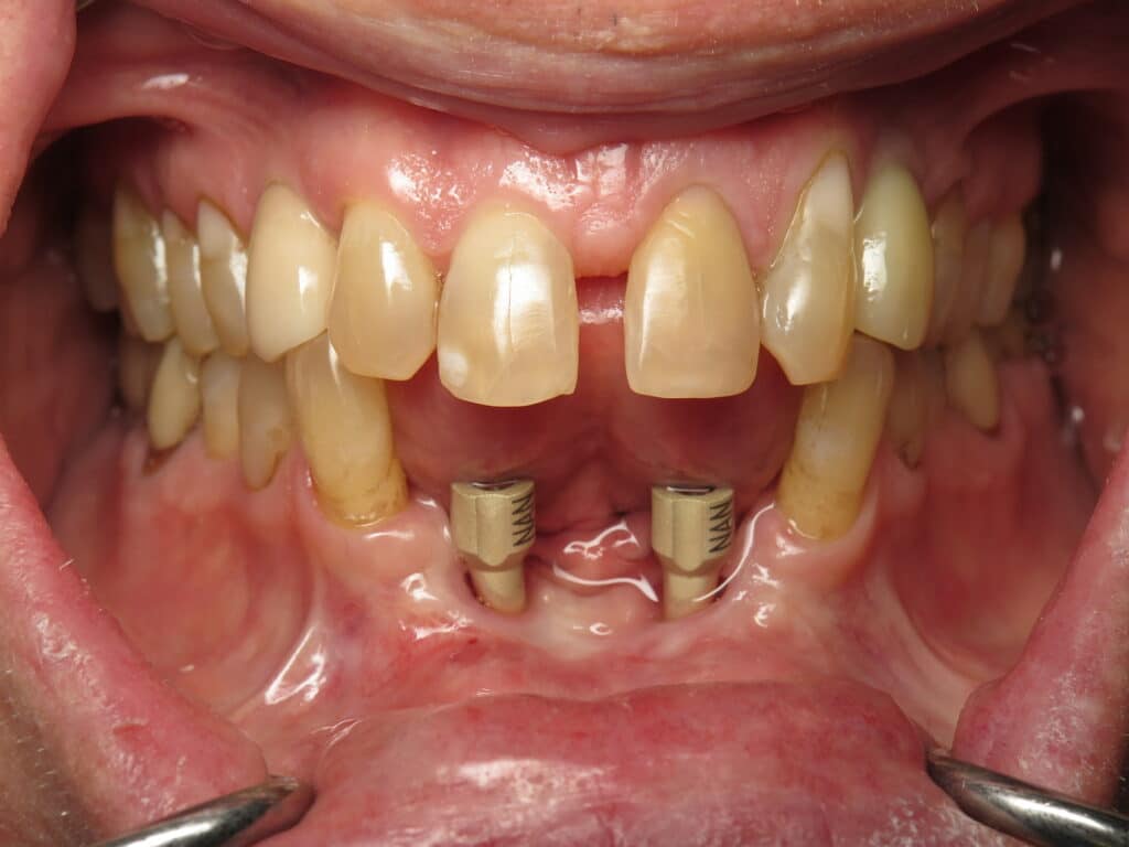 Digital scanning impression post on dental implants.