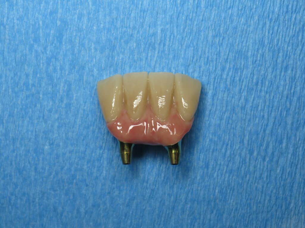 Lower front teeth bridge with pink porcelain and custom abutments
