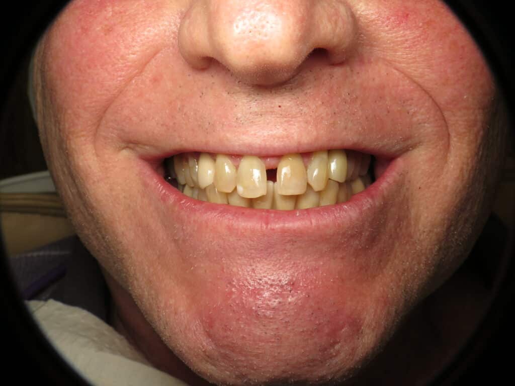 Smile showing good color match and lips support of the dental implant bridge